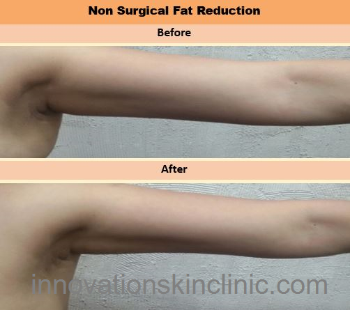 Fat Reduction 3